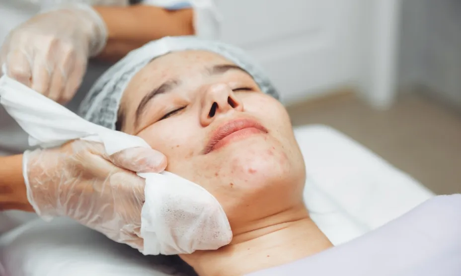 Acne Scar Treatment